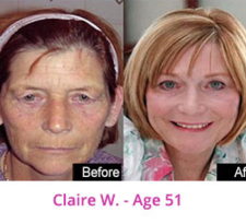 strecthmark removal call+27738618717 drmamaphinah
